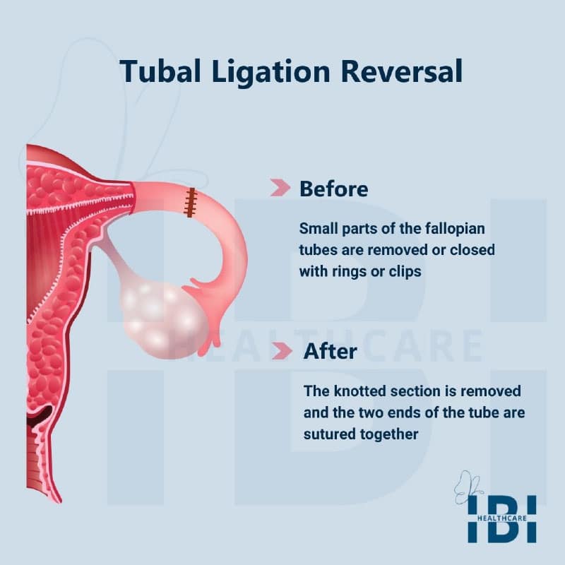 tubal ligation reversal